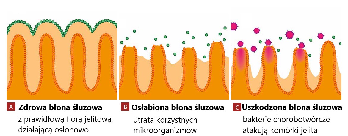 Zdrowa błona śluzowa  w porównaniu z błoną osłabioną i zasiedlona niepożądanymi bakteriami